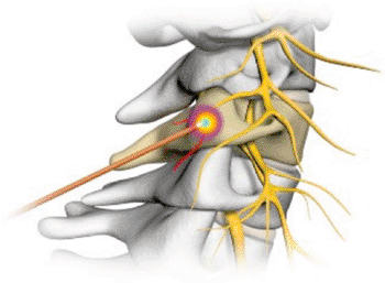 Image: The Cervicool system probe tip at the cervical facet joint (Photo courtesy of Kimberly-Clark). Image: The Cervicool system probe tip at the cervical facet joint (Photo courtesy of Kimberly-Clark).